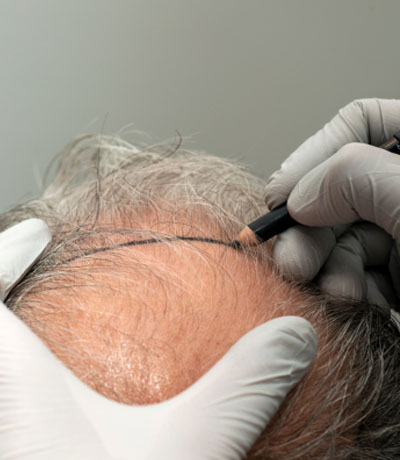 Trapianto Capelli con Tecnica FUE