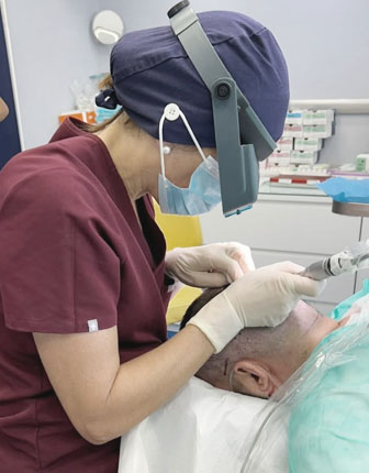 trapianto dei capelli con tecnica fue