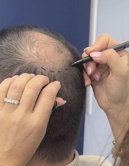 Trapianto dei capelli con tecnicafue