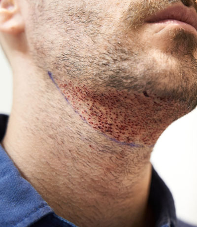 Trapianto della barba